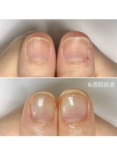 リモネイル(Rimo nail)/爪育成　美爪育成