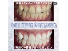 ライトビューティー 本八幡店(LIGHT BEAUTY)/犬歯も目立たないナチュラル歯