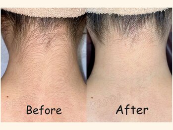 パッパ(PAPPA)/気になるうなじ脱毛もPAPPAへ