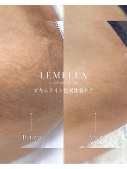 ルアナ(LUANA。)/ルメラビフォーアフターYゾーン