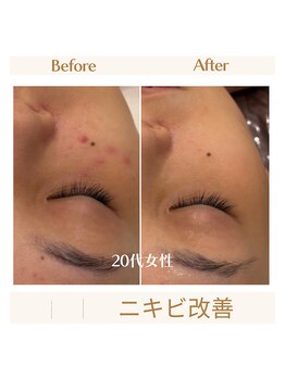 スカーレット 北参道(Scarlett)/20代ニキビ改善