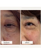 ゆたか鍼灸院/1年間お顔に鍼をした結果