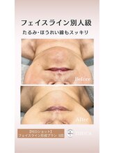 ジヒカ(ZIHICA)/【REDSHOT】フェイスライン形成