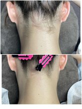 グロー(GLOW)/うなじ脱毛