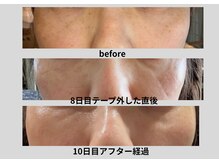 サロン リノ(salon rino)の雰囲気（塗るだけ、新しいシミケア体験。アフターケア中。）
