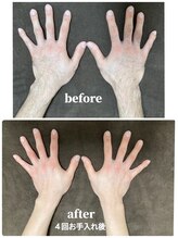 ビジュク(B-juku)/メンズ手（ビフォーアフター）