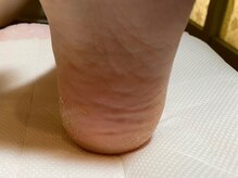ビサンテ サロン/中々乾燥して良くならない足裏に