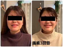 スターエステ(STAR ESTHE)/小顔矯正＋小顔ハイパーナイフ