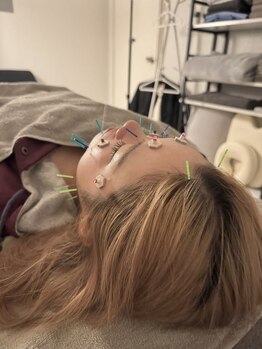 ラフテル鍼灸整骨院/堀江/西大橋カフェ帰りに美容鍼