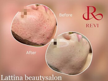 ラティーナ(Lattina)/陶肌トリートメント