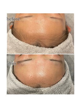 アデル 久留米(ADEL)/フェイシャルワックス《額》