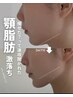 【顎下全体(耳下までOK)】】小顔・Vライン形成溶解ピストル  44,000円→
