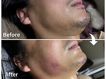 サロンドモモ(SALON de MOMO)/小顔★顎下ビフォーアフター