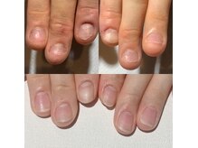 自爪育成、深爪・トラブル爪改善も行っております。