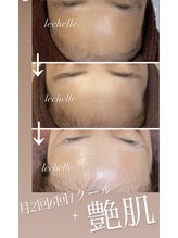 レシェルサロン(Lechelle Salon)/ダクトピーリング
