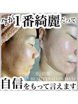 エムアンドエム(M&M)/毛穴改善コース