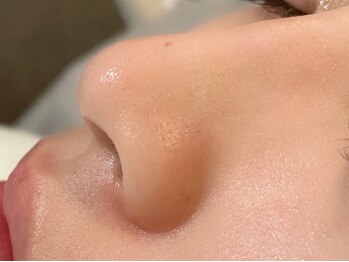 ミニョンプラス(Mignon+)の写真/最新毛穴洗浄で毛穴5ミリ深い汚れも取り除く今まで実感できなかったうる艶肌へ★ニキビケアにも◎