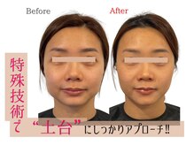 小顔製作所 心斎橋院/本格小顔矯正　実例１