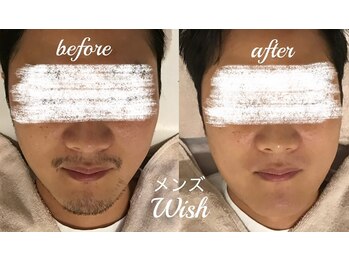 メンズ脱毛 ウィッシュ(Wish)/ダブル脱毛ならばメンズWishへ