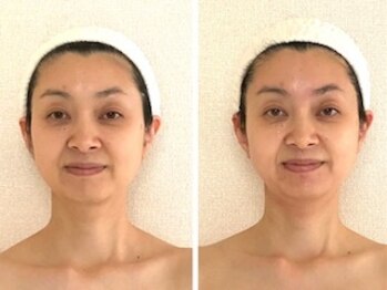 ル シエル(Le Ciel)/40代/一度の施術左before右after