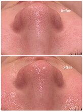 エノアビューティー(ENOA beauty)/毛穴レス/ハーブピーリング