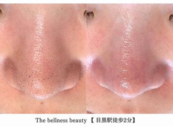 ザ ベルネス(The bellness)/【毛穴洗浄】東京/目黒駅