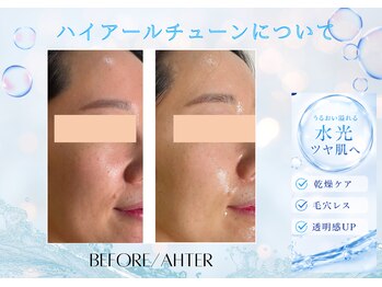 ユアーズ ビューティー(YOURS beauty)/ハイアールチューン