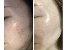 エスポワール ビューティ(Espoir beaute)/光フェイシャル