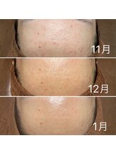 ルーチェエムベルシック(Luce.MBelChic)/ニキビケア★