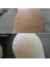 メゾリーナ(MAISOReNA)/水光ピーリング