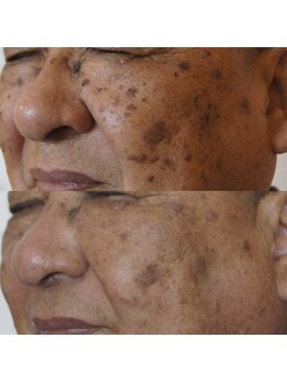 エトル(etole)/70代お客様症例写真