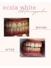 エクシアホワイトニング 奥田店/ホワイトニングビフォーアフター