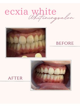 エクシアホワイトニング 奥田店/ホワイトニングビフォーアフター