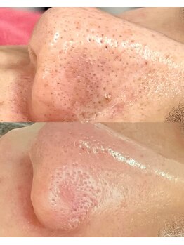 クレーヌ(CREINE)/黒ずみ毛穴がすっきり