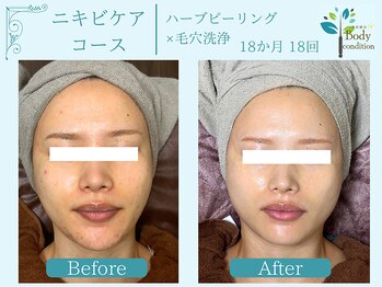 ボディコンディション/ハーブピーリング/毛穴洗浄/小顔