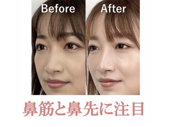 ラプリボヤージュ 藤沢店(Raplit)/ 隆鼻＋輪郭矯正40分10回コース