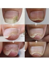 ベルタネイル(BELTA NAIL)/剥離による色づいた爪