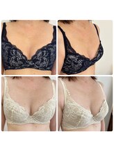 アンド ユー(and.yu)/バストアップ施術×光豊胸2ヶ月