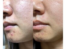 ユウビ ビューティー サロン(Yuubi)/【peel stage】ハーブピーリング