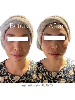 プランツ(PLANTS)/30代／１回／ほうれい線