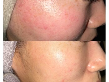 ル シーニュ/肌の赤み