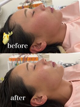 マホロバ(mahoroba)/美容鍼ララピール