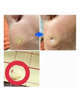 ナチュエイド/魚の目