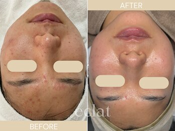 エクラ(eclat)/慢性ニキビケア/肌全体が綺麗に