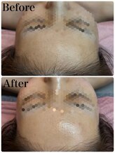 リレイスフクオカ(RelaceFUKUOKA)/ベビースキンコース症例