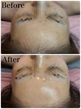 リレイスフクオカ(RelaceFUKUOKA)/ベビースキンコース症例