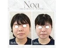 ノア 新宿(Noa)の雰囲気（ハーブピーリング/ニキビケア/小顔矯正/美肌/毛穴/たるみ/新宿）