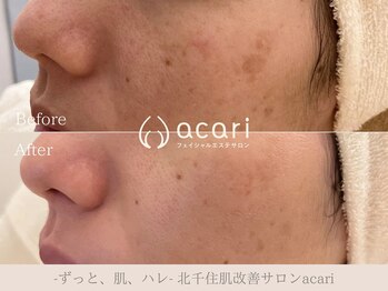 アカリ(acari)の写真/長年の悩みにさよなら！塗るシミケアで、驚くほどの透明感あふれる美肌へ☆