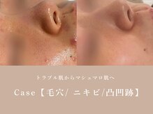 シーヴォーク(Cveauque)/ハーブピーリング｜ハーブリプロ