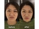 エスピーエー 桂坂(S.P.A)の写真/【国家資格者の確信】細胞から立て直すオーダーメイド美容鍼。東洋学に基づく、一生モノの素肌美を。
